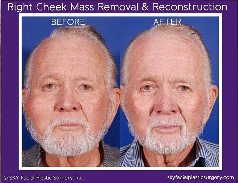 Reconstructive Surgery Before & After