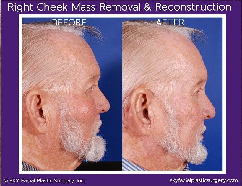 Reconstructive Surgery Before & After