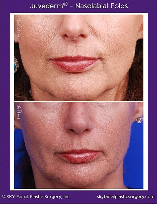 Nasolabial Fold Filler Before & After