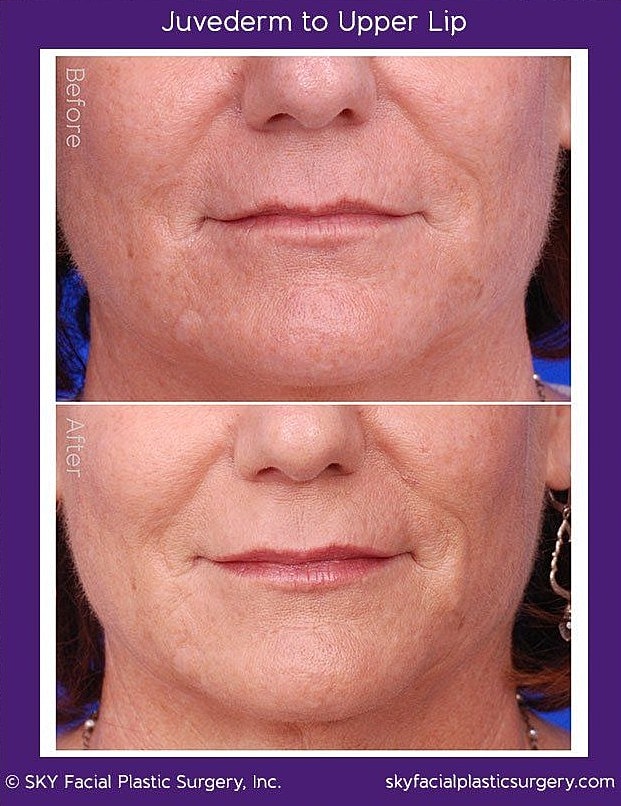 Lip Filler Before & After