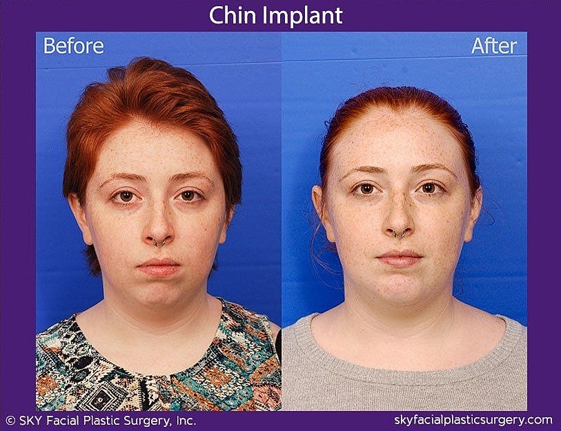 Chin Implant Before & After