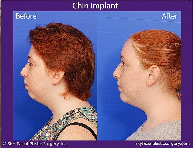 Chin Implant Before & After