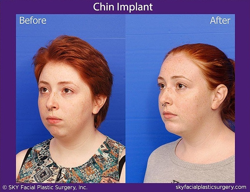 Chin Implant Before & After