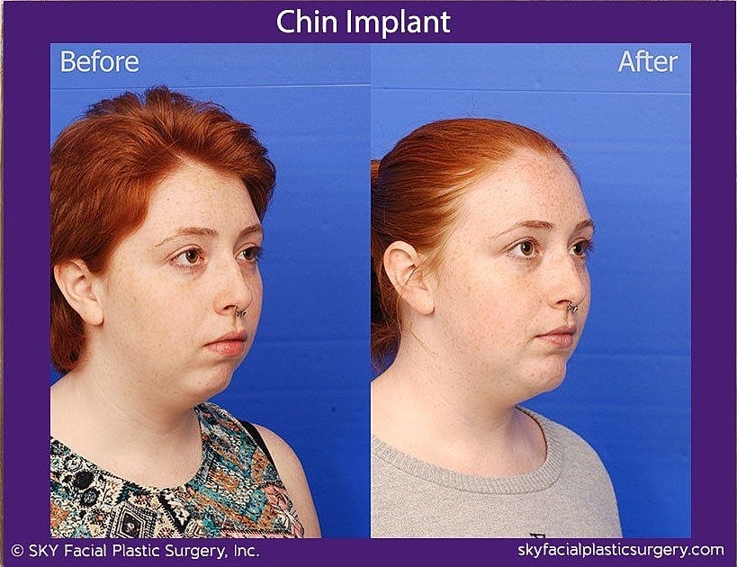 Chin Implant Before & After