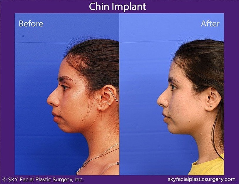 Chin Implant Before & After