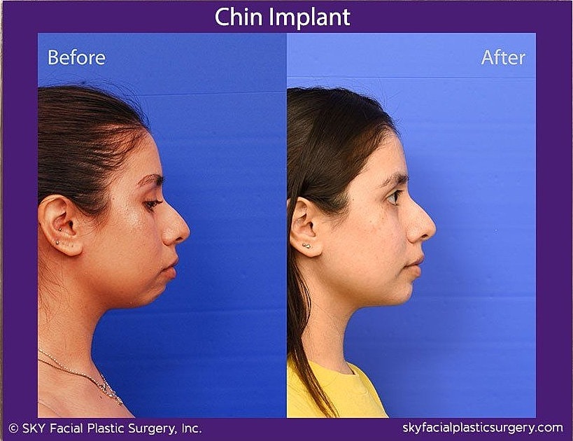 Chin Implant Before & After