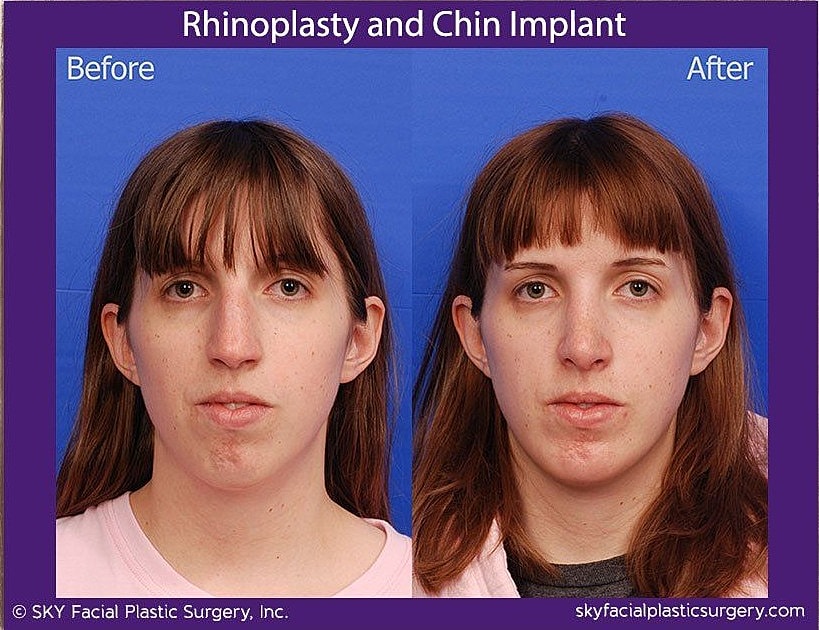 Chin Implant Before & After