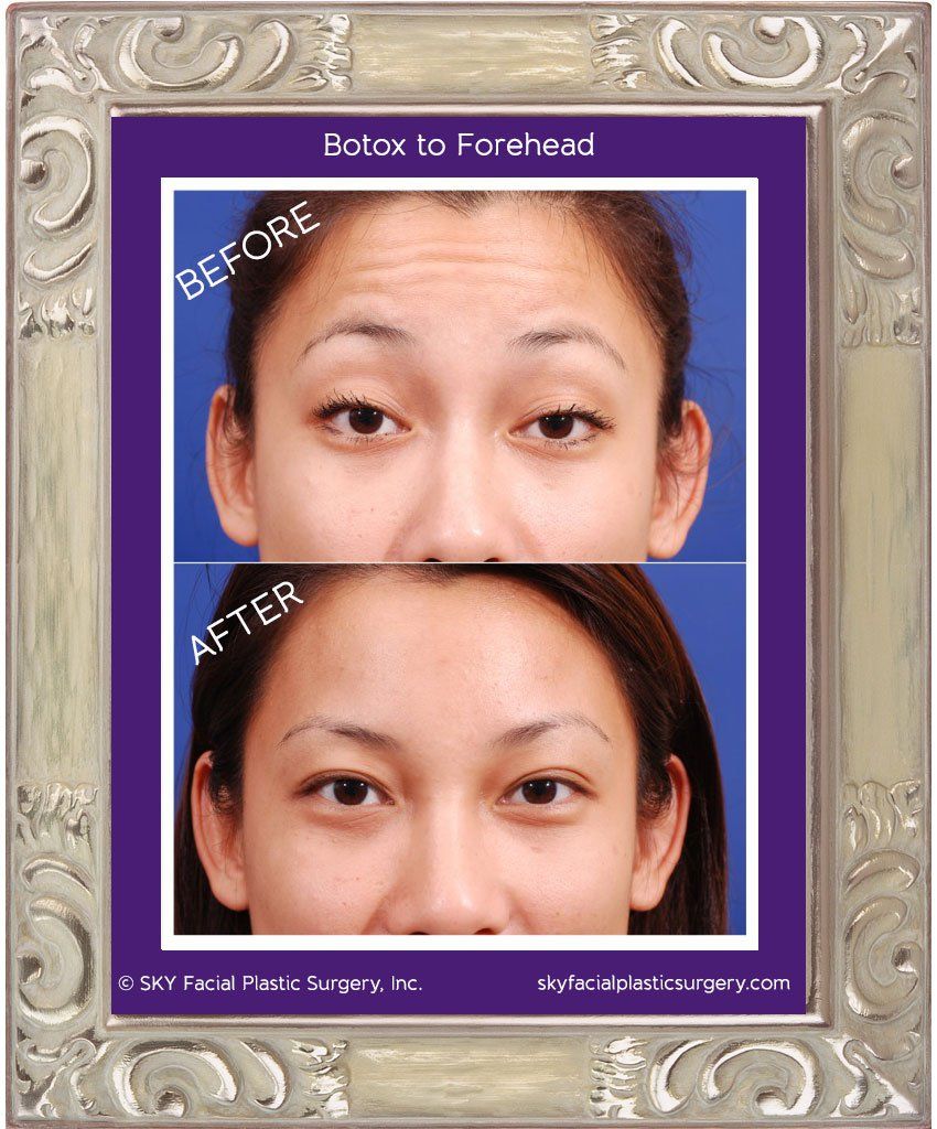 Diary of a New Patient: Botox Treatment